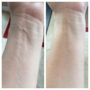 Danielle's arm