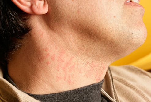 Get Rid Of Razor Burn