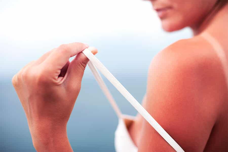 how to treat a sunburn